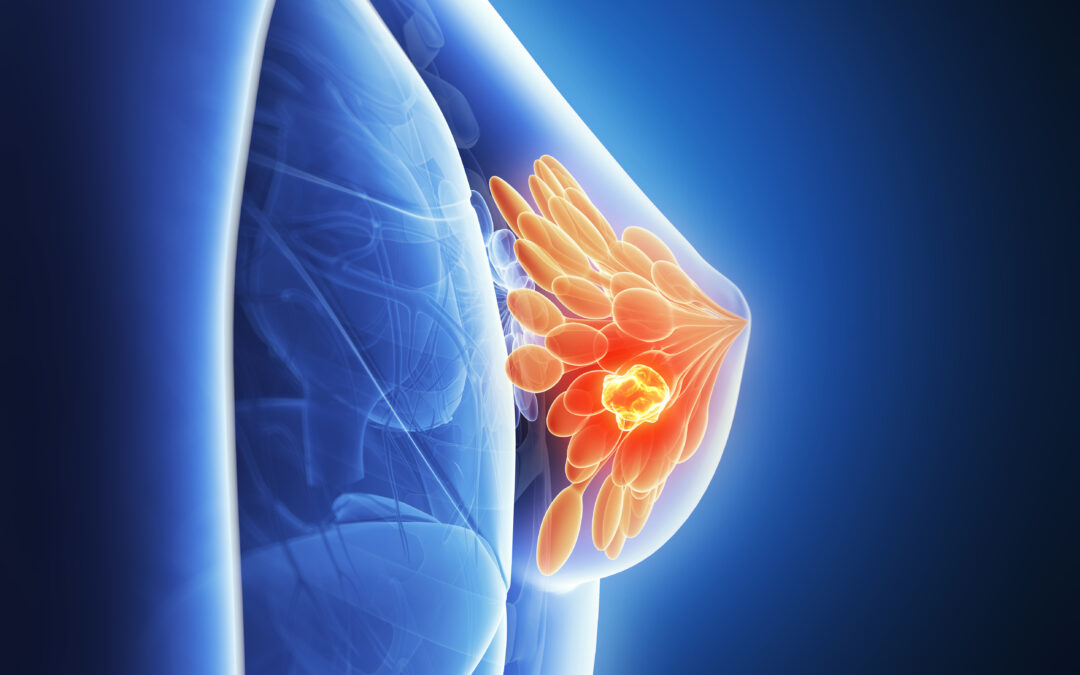 Рак груди: ИИ помогает принять решение об операции после химиотерапии